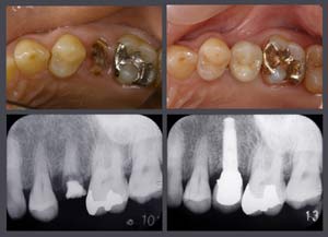 implant_s.jpg